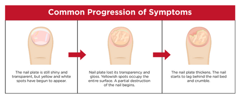 Common Progression of nail fungus symptoms