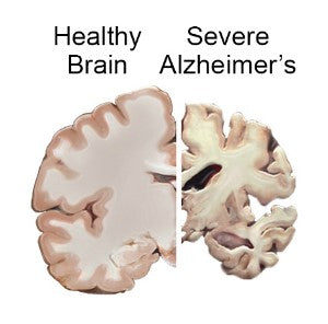 Image of a brain, healthy side is full and plump, the Alzheimer's side is smaller with gaping areas where the brain has atrophied