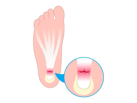 Diagram van de anatomie van de menselijke voet met nadruk op de fascia plantaris