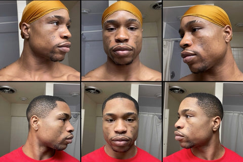 Client 1 month transformation using Turmeric Soap x Clear Right Serum