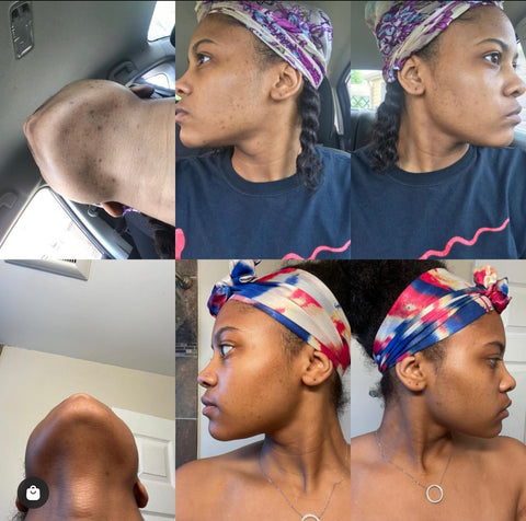 Client 2wk transformation using Turmeric Soap