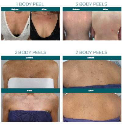 Body Chemical Peel Atlanta