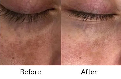 Epifager Forte cream Before and After