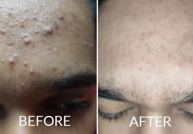 Salyzap Anti Acne Kit-Customer results