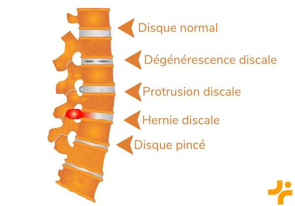 protrusion discale - Dégénérescence du disque intervertébral ou discopathie dégénérative