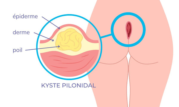 Le kyste pilonidal