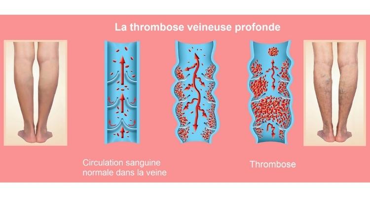 Thrombose voyage