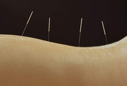 Une femme adepte de l'acupuncture