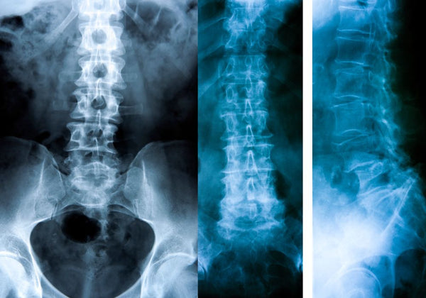 douleurs du spondylolisthésis