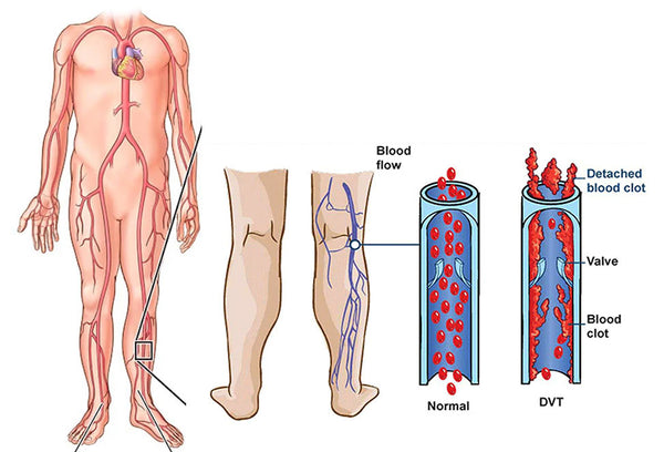 Blood collects in your lower extremities and the pressure within veins increases.