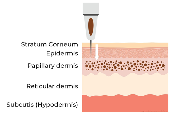 Cosmetic tattoo pigment placement, with skin layers