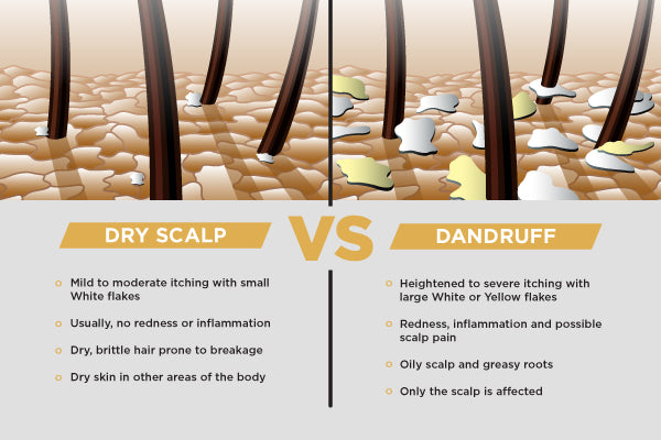 What Causes Dry Scalp and Dandruff?