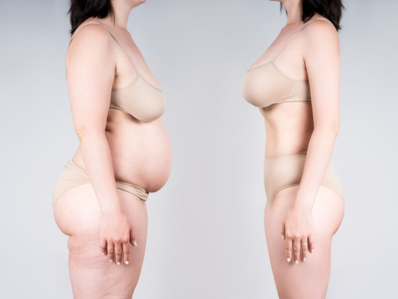 Woman before and after weight loss