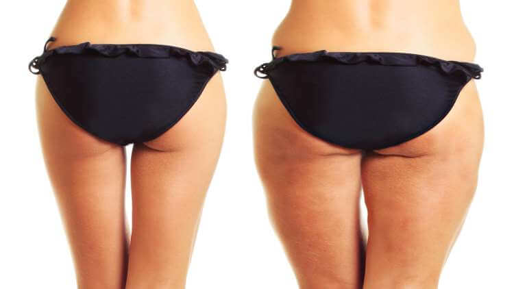 Before and after cellulite