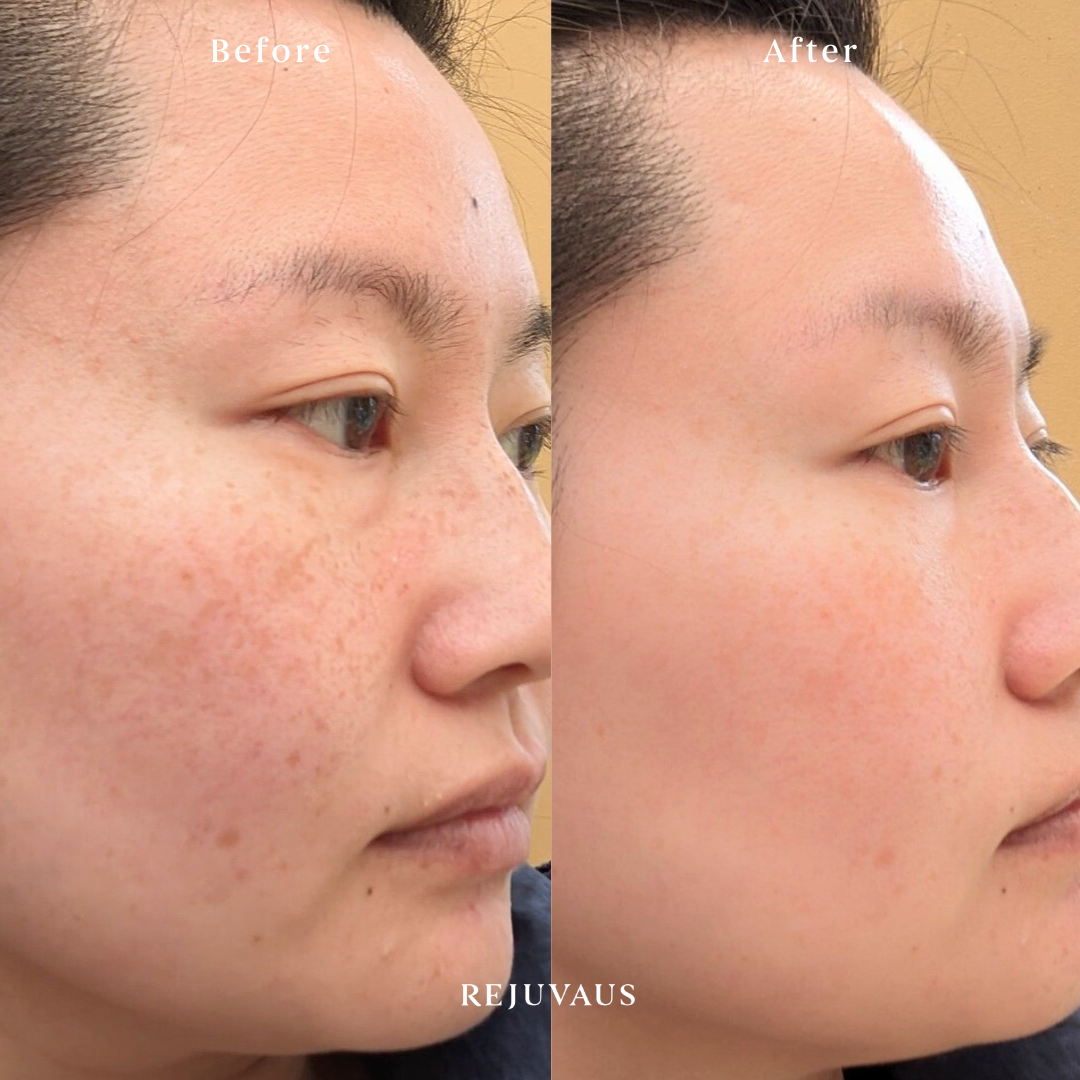 pigmentation serum before after