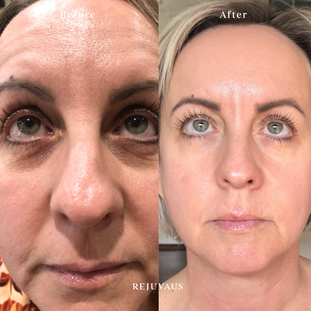 Before and after Eye Serum