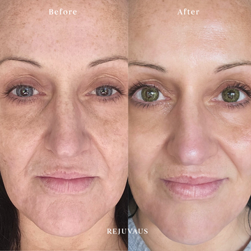 Before after anti aging skin