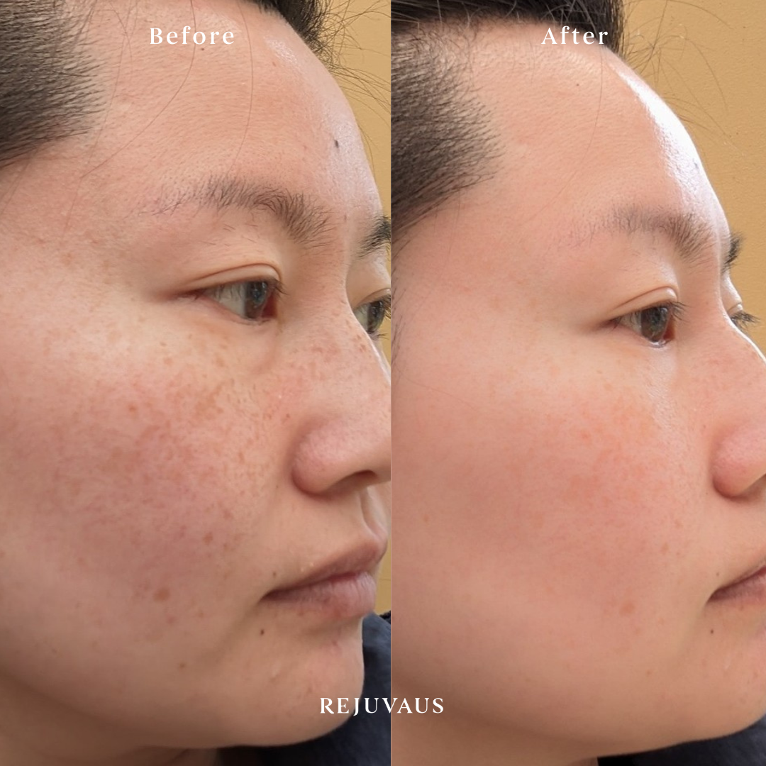 Rejuvaus Pigmentation Before & After