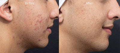 before-after-acne2.jpg__PID:2533aecf-a011-4452-94bc-8039e2d464d1