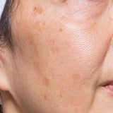 Pigmentation & Sun Damage