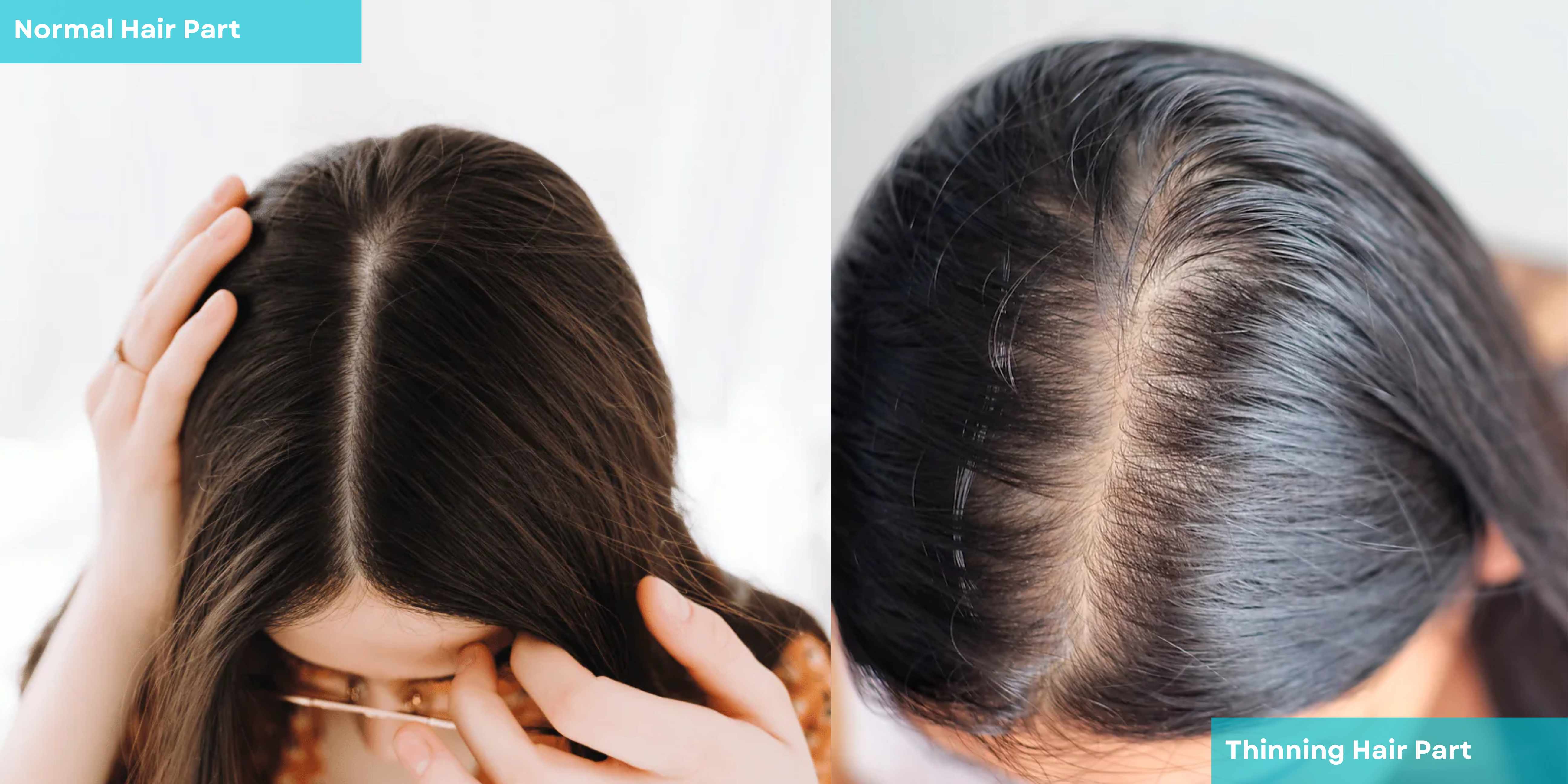 hair thinning part line