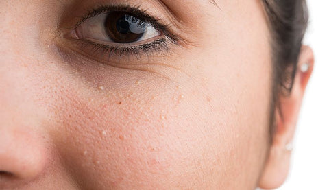 Woman with milia under eyes and cheeks