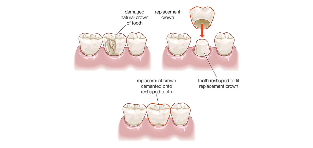 Процедура установки зубной коронки объяснена на изображении. Инфографика.