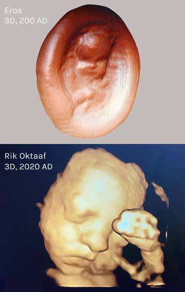 3D scan of a Roman glass paste intaglio of Cupid as a baby, 2nd century, versus a 3D echography of baby Rik in 2020