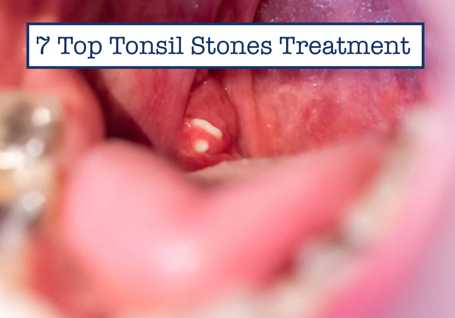 Can I Take Medicine For Tonsil Stones