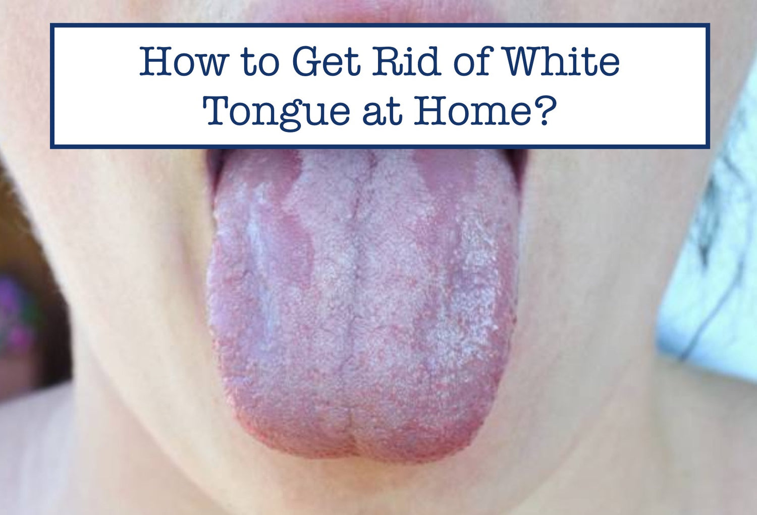 how-to-get-rid-of-white-tongue-at-home