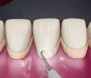 Zähnepinsel, elektrisch aus Silikon für Kalkül, Dental, Zahnreinigung, elektrisch für Teller, Flecken, Zähne, von Tatar, Berechnung, Dental, blau bronmart.españa.