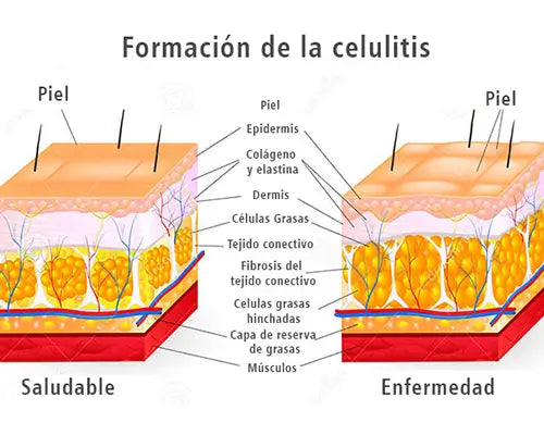 Bild der Struktur der von Cellulite betroffenen Haut
