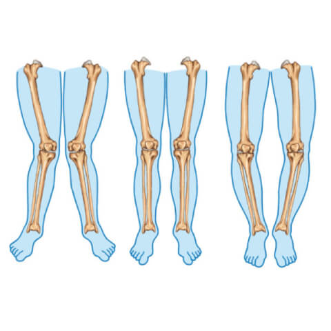 corriger les jambes et les genoux courbés ensemble bronwellys
