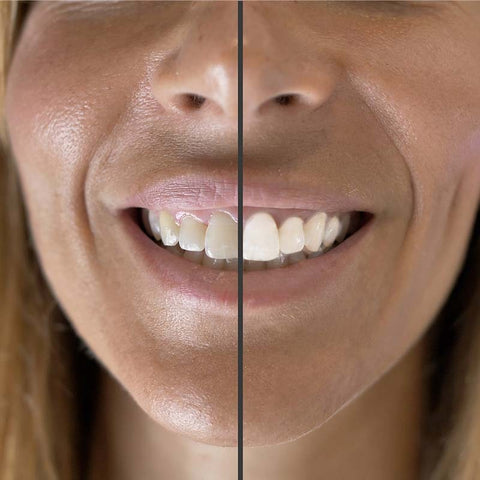 Kit de clareamento dental, rápido mais branco de dentes / eec | Bronwelys ©