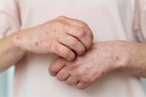 eczema skin allergy rash