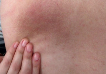 Woke up to find a rash on my breast.. what's causing this? :  r/medical_advice