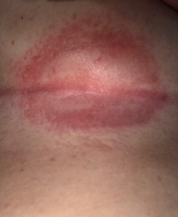 Rash Between Breast not sure of what it could be , it burns at