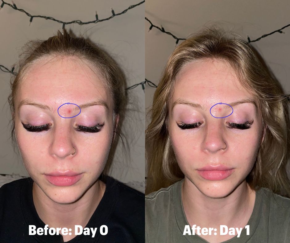 Solawave Bye Acne Before and After