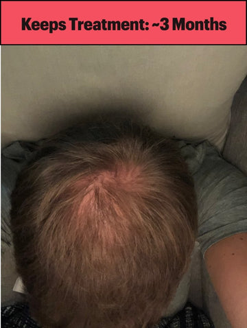 Keeps Hair Loss Review 2021 – We Tried for One Year