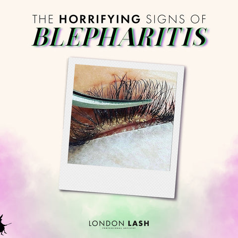 What blepharitis looks like