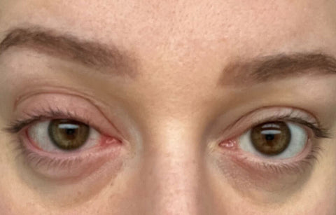 Swollen eyes from getting lash extension remover in eyes
