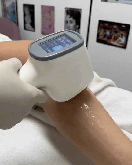 diodenlaser-behandlung.gif