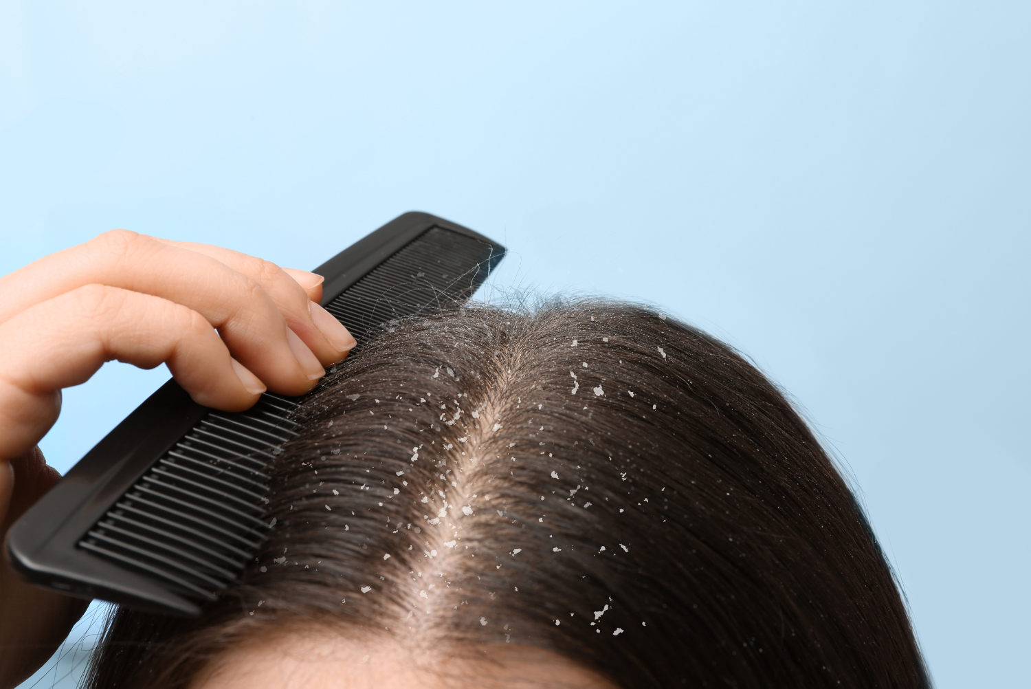 How to Get Rid of Dandruff: Effective Treatments and Tips