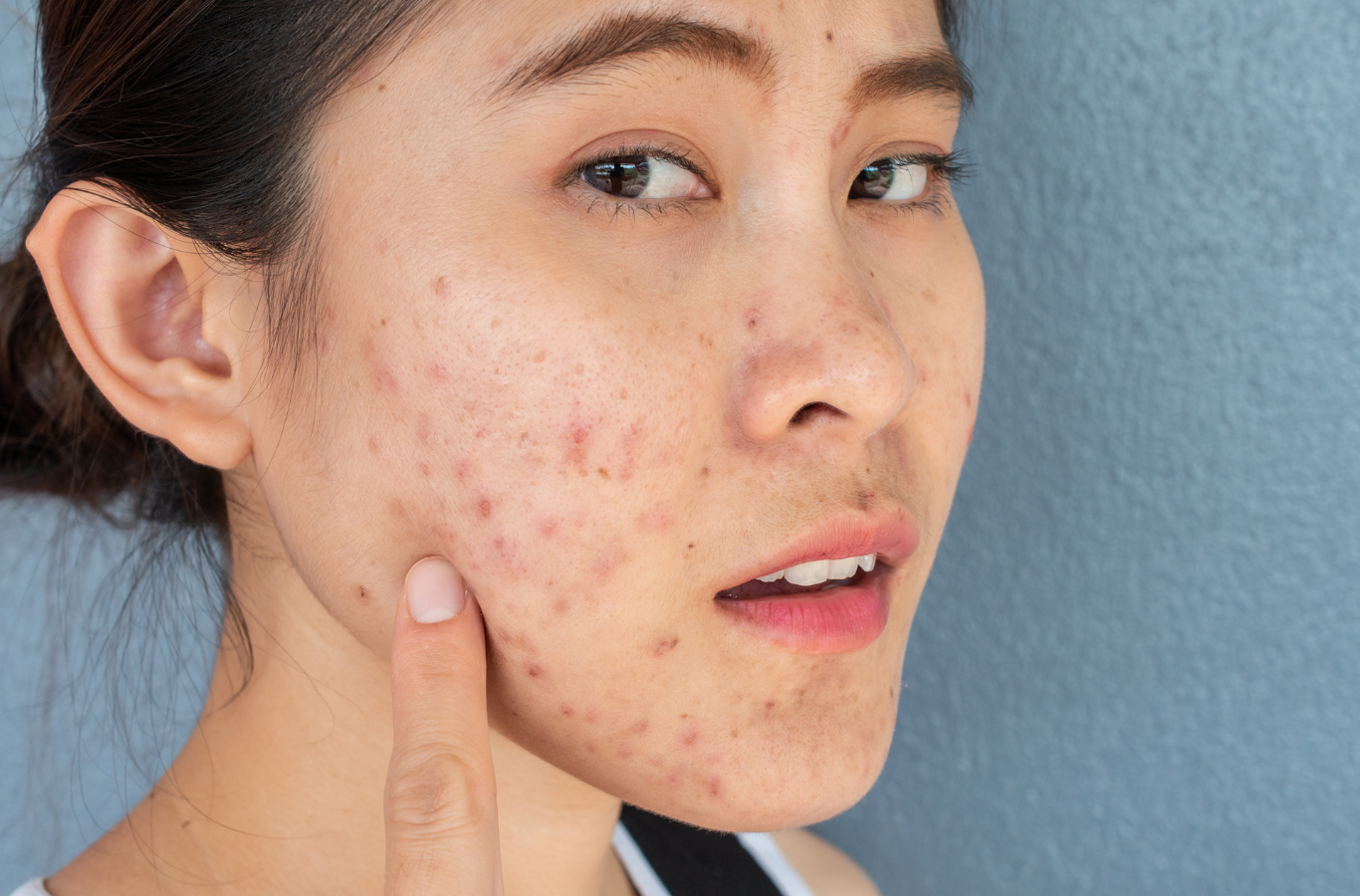 5 Products That Helped Fade My Post-Acne Dark Spots