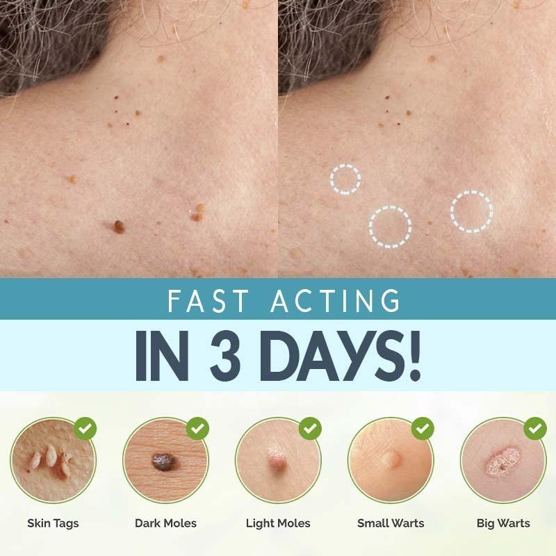 SpotOff SkinTag RemoverPatches 