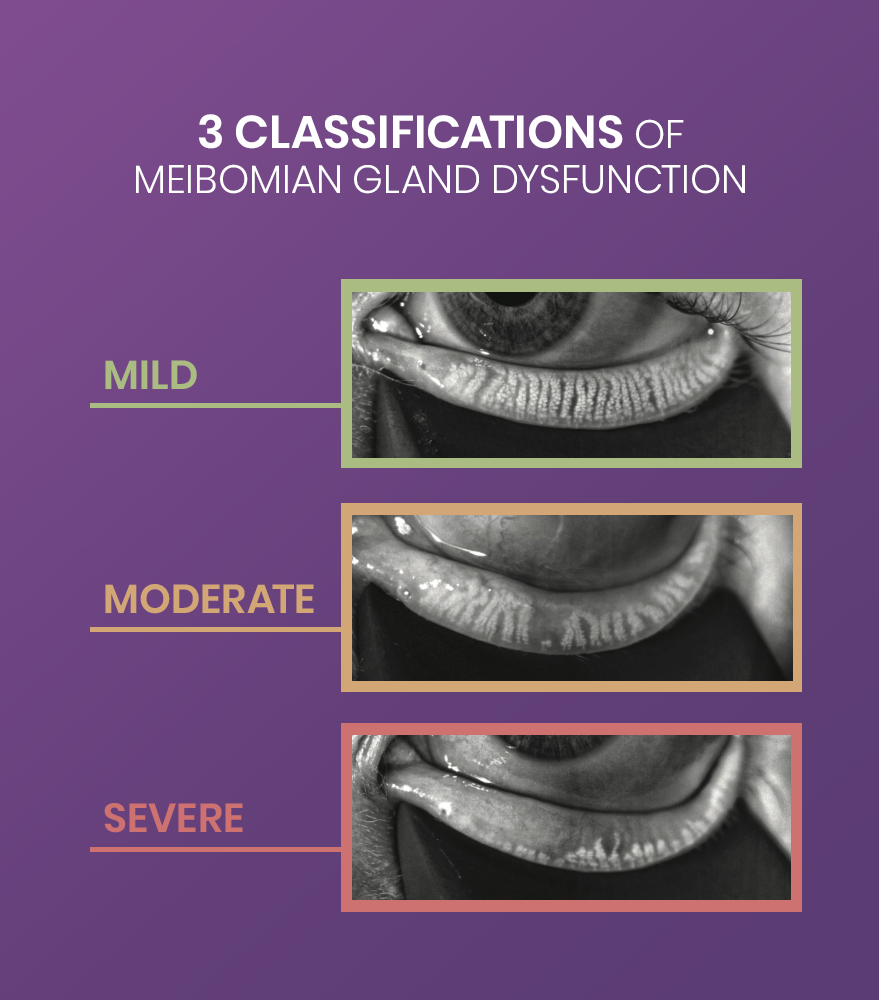 3 Classifications Of Meibomian Gland Dsyfunction