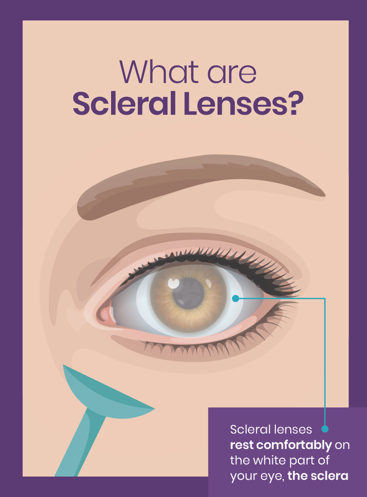 What are scleral lenses?