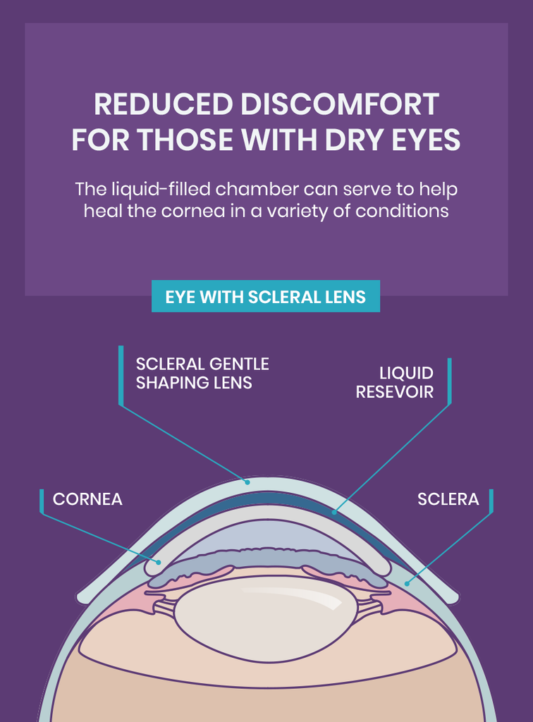 Scleral lense on eye
