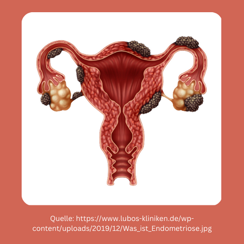 Endometriose Abbildung