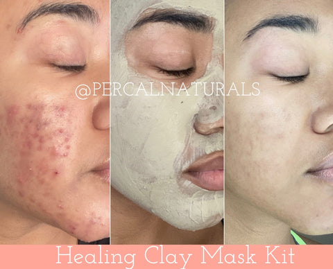 What Is Bentonite Clay & Why Is It So Effective In Treating Acne – PerCal  Naturals
